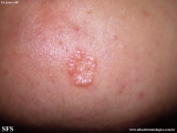 trichoepithelioma dermoplastic