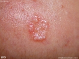 trichoepithelioma dermoplastic