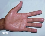 hyperhidrosis