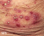 impetigo