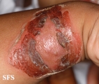 impetigo