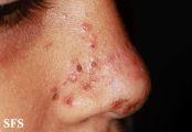 impetigo