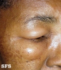 angioedema