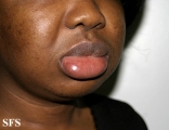 angioedema