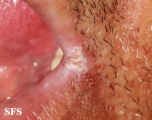 angular cheilitis