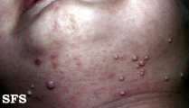 molluscum contagiosum