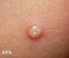 molluscum contagiosum