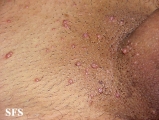 molluscum contagiosum