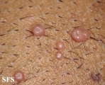 molluscum contagiosum