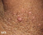 molluscum contagiosum