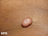 molluscum contagiosum