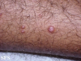 molluscum contagiosum