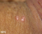 molluscum contagiosum