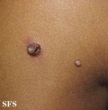 molluscum contagiosum