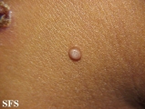 molluscum contagiosum