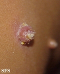 molluscum contagiosum