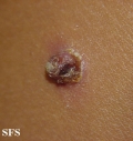 molluscum contagiosum