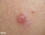 molluscum contagiosum