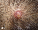 molluscum contagiosum