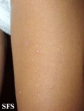 molluscum contagiosum