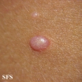 molluscum contagiosum