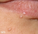 molluscum contagiosum