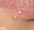 molluscum contagiosum