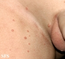 molluscum contagiosum