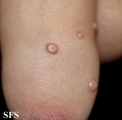 molluscum contagiosum