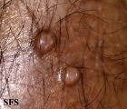 molluscum contagiosum