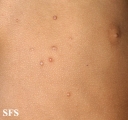 molluscum contagiosum