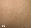 molluscum contagiosum