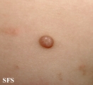 molluscum contagiosum