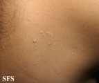 molluscum contagiosum