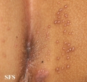 molluscum contagiosum