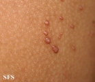 molluscum contagiosum