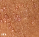 molluscum contagiosum