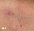 molluscum contagiosum