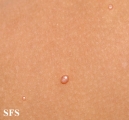 molluscum contagiosum