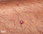 molluscum contagiosum