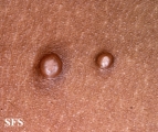 molluscum contagiosum