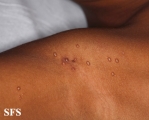 molluscum contagiosum