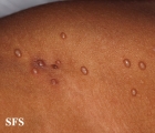 molluscum contagiosum