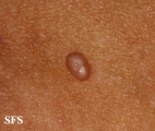 molluscum contagiosum