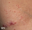 molluscum contagiosum