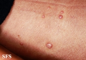 molluscum contagiosum