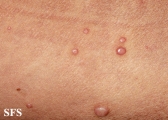 molluscum contagiosum