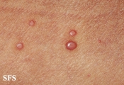 molluscum contagiosum