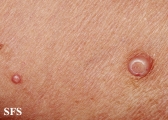 molluscum contagiosum