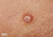 molluscum contagiosum